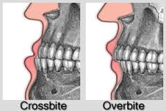 My Journey for Braces & Jaw Alignment